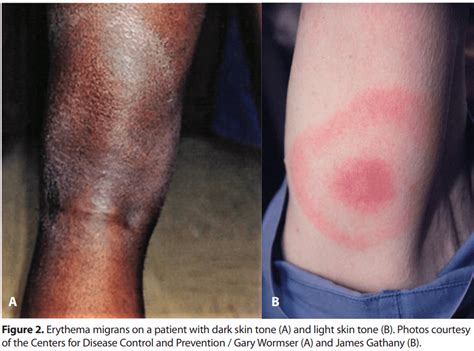 erythema migrans pronunciation|erythema migrans on dark skin.